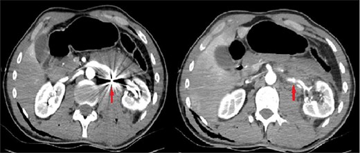 The initial computerized tomographic angiography image of the bullet core adjacent to the middle segment of the left renal artery and the renal pseudoaneurysm.