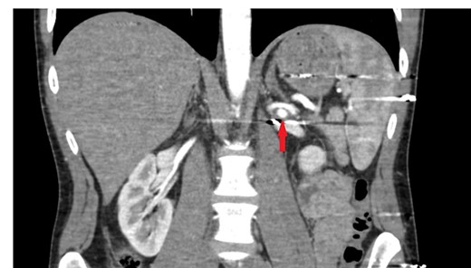 Tomographic angiography image of the enlarged renal pseudoaneurysm and the retained bullet core.