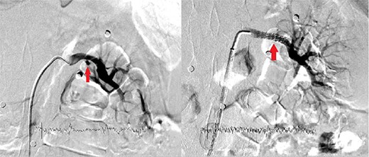 The filling image of the left renal pseudoaneurysm and the inserted covered stent.