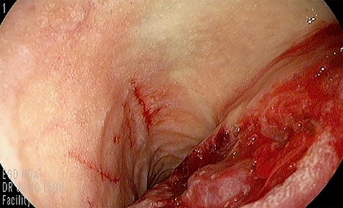Duodenal bulb ulcer with jagged edges and an adherent clot.