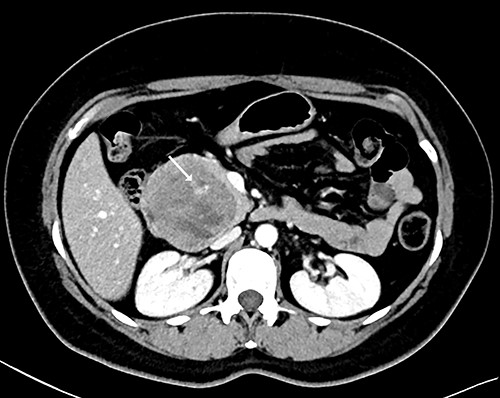 CT scan showing a well-defined heterogeneous 6.7 cm mass with solid and cystic components arising from the head of the pancreas with enhancement of contrast in the solid component, and some areas with active bleeding (white arrow). The tumour was in direct proximity to the duodenum.