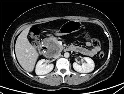 CT scan showing that tumour reduced to 6 cm, containing an air cavity (white arrow) and communicating with the duodenal lumen (arrowhead).
