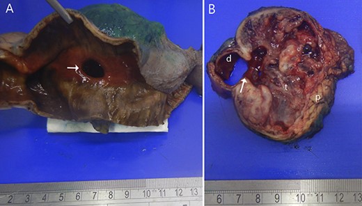 Resected specimen. (A) Shows the duodenal bulb ulcer (white arrow). (B) The gross appearance of the cut surface shows a round tumour (t) composed of solid areas, necrosis, haemorrhage and in communication with the duodenal lumen (d). Normal pancreas (p).
