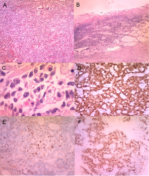 (A) Histologically, the tumour had neoplastic epithelioid cells growing with pseudopapillary architecture and hyalin/myxoid stroma (haematoxylin–eosin stain, 10×). (B) Infiltration and ulceration of the duodenum were observed (haematoxylin–eosin stain, ×10). (C) Some neoplastic cells contained hyaline globules (haematoxylin–eosin stain, ×40). Immunohistochemical expression of β-catenin (D), progesterone receptor (E) and synaptophysin (F) (×20).