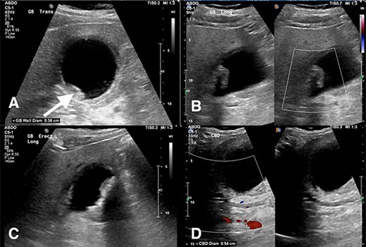 (A) Transverse view of the gallbladder showing a 3.6 mm wall diameter. Inferior arrow also shows small stones and sludge. (B) Longitudinal view of the gallbladder again showing mobile sludge. (C) Longitudinal view of the gallbladder showing a small amount of pericholecystic fluid. (D) Measurement of the CBD diameter at 5.4 mm (within normal limits).