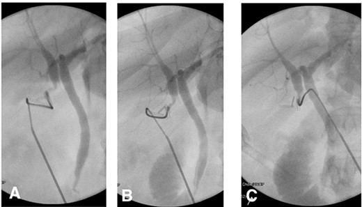 (A) IOC showing the point of cystic duct cannulation with retrograde contrast injection revealing a connection with a duplicated CHD draining the right system and another CHD draining the left system proximally. (B) and (C) Further contrast injection demonstrating no filling defects in the distal common system with good flow into the duodenum.