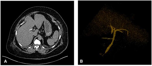 (A) Axial CT image showing the cholecystectomy clips at the base of a duplicated CHD with the corresponding CHD on the medial aspect. (B) 3D reconstruction demonstrating the CHD duplication with a single distal draining CBD.