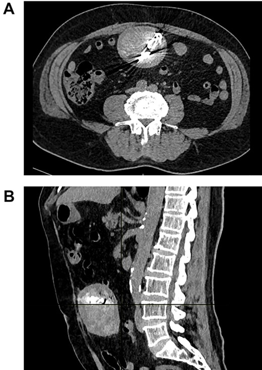 (A) CT the mass is seen in the abdomen with radiopaque material on its center. (B) CT the mass attached to the bowel.