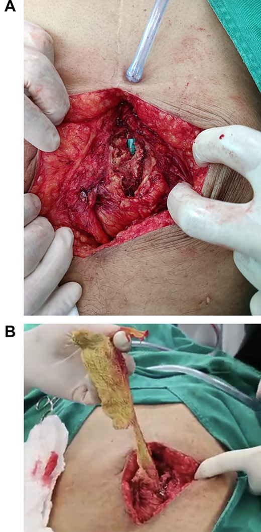 (A) the surgical cotton pad is seen in the abdomen. (B) Surgery, the pad is removed from the abdomen.