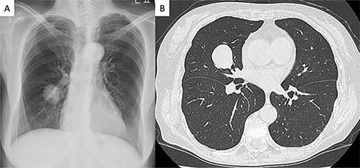 Radiologic findings (A) Chest radiograph showed a round mass in the right middle lung field. (B) Computed tomography image showing a 28-mm nodule in the middle lobe of the right lung.