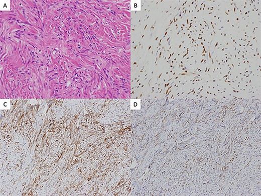 (A) histology hematoxylin and eosin staining of the resected tumor revealed proliferating spindle-shaped cells with a random fascicular arrangement with continuity to the pulmonary interstitium (×40). Immunohistochemical findings revealed the tumor cells to be positive for (B) STAT6 (×200), (C) CD34 (×200), and (D) bcl-2 (×200)