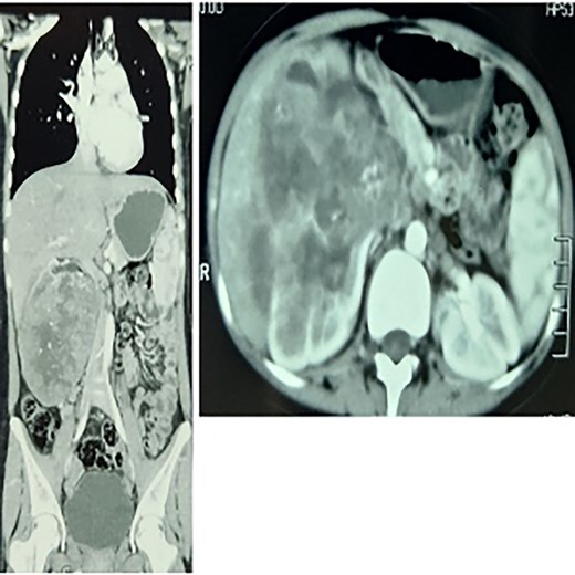 To the left: coronal section multiple-slice computed tomography slice showing the lump at the greatest diameter, to the right a transverse section showing a renal mass.