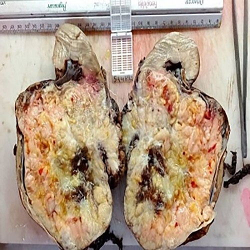 Macroscopic view of the tumor.