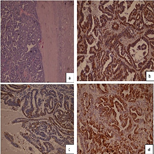 (a) Hematoxylineosin staining, (b) diffuse positive Vimentin staining (c) focally positive CK7 staining (d) CK19 positive staining.