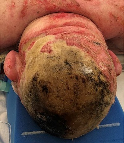 Burn Injury prior to excision, with patient in prone position.