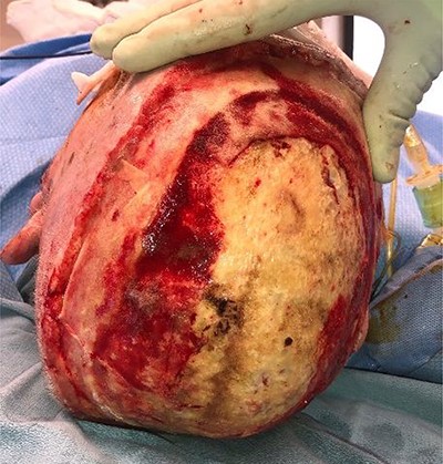 Following excision of scalp burn, down to and including outer table of the skull.