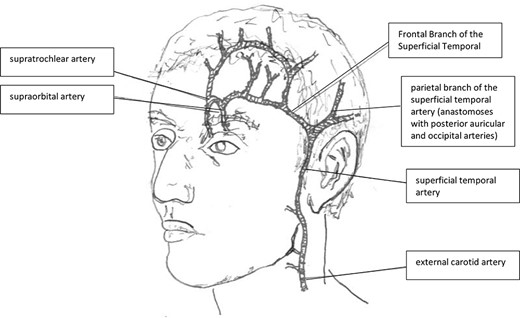 Surgical anatomy of the supraorbital and superficial temporal arteries, their origins and terminal branches relevant in this case.