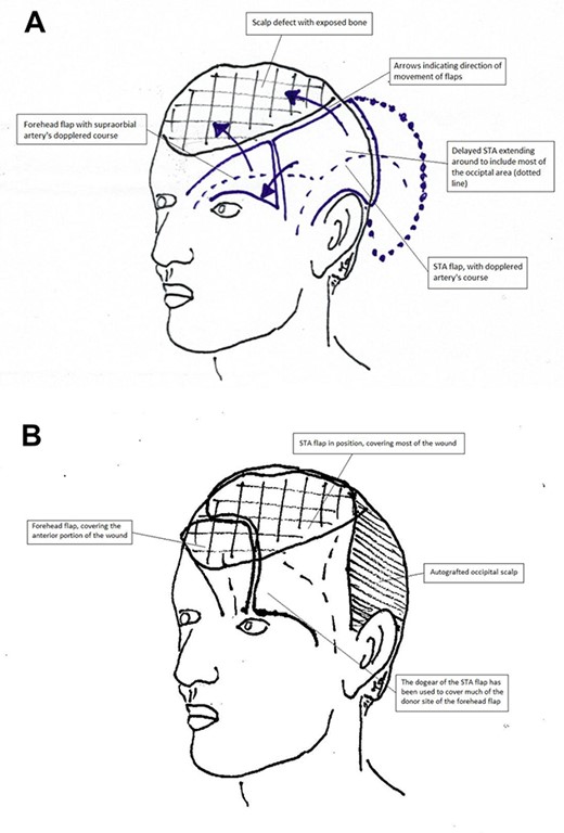 (A, B) Operative plan for coverage of the defect. The STA flap would transpose to cover the posterior part of the wound, whereas the forehead flap would cover the anterior. Note how the anterior portion of the STA flap which first creates a dog-ear anteriorly, then aids in the closure of the distal portion of the forehead flap donor site.