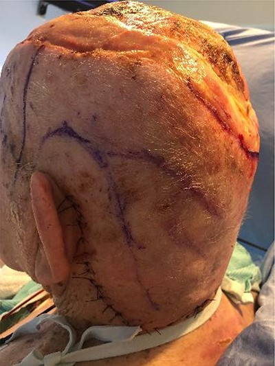 After the first delay procedure. Note the sutures around the distal extent of the delayed flap. The Doppler signal is marked with pen within the delayed STA flap.