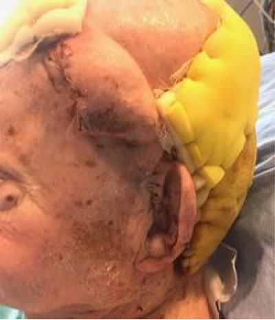 After initial inset of the STA flap, demonstrating large dog-ear, ultimately used to partially cover the donor site of the forehead flap.
