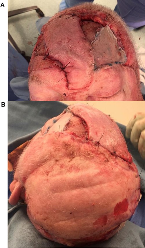 (A, B) Axial Forehead flap, with its donor site covered by the dog-ear of the STA flap and a sheet graft to the remaining area.