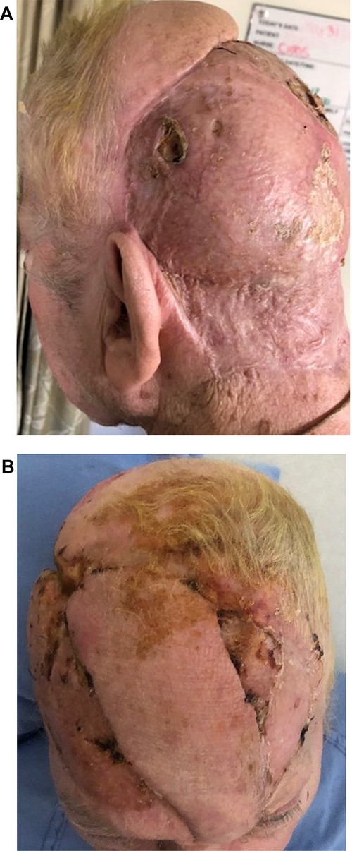 (A, B) Appearance on discharge from hospital.