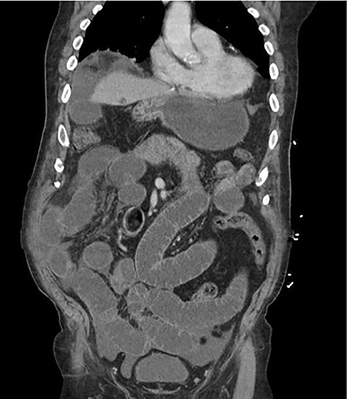 Abdominal CT scan on patient initial presentation.