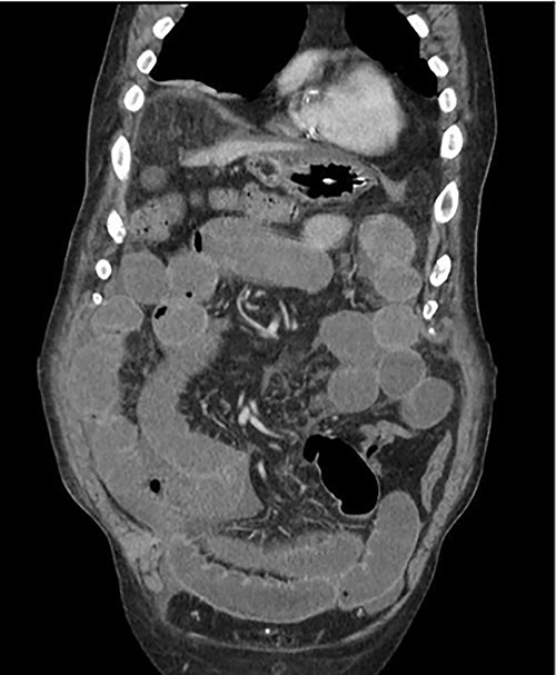 Repeat CT scan after attempted conservative management.
