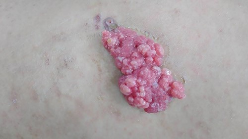 A solitary mass, with pink-brown color, measurement of 6.5 × 3 × 2 cm, soft-medium consistency at left flank region.