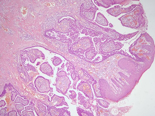 H&E staining, 4× magnification. Cystic invaginations of the infundibular epithelium projecting into the dermis, covered by a double cell layer.