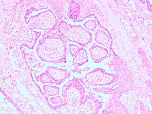 H&E staining, 4× magnification. Verrucous (papillomatous) epidermal hyperplasia with hyperkeratosis and hypergranulosis.