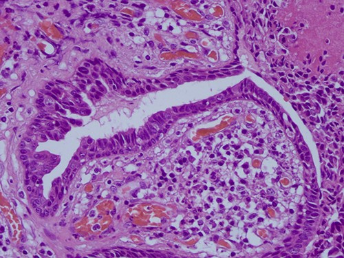 H&E staining 10× magnification. Proliferation of glands with prominent papillary architecture.