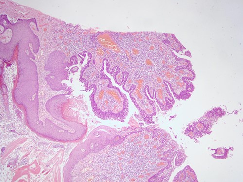 H&E staining 10× magnification. Irregular duct-like structures and cystic spaces.