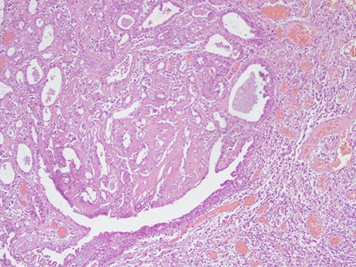 H&E staining 40× magnification. Fibrous cores of papillae contain numerous plasma cells and are lined by a double layer of cuboidal columnar epithelium.