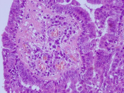 H&E staining 40× magnification Glands with double layer of cuboidal columnar epithelium and numerous stromal plasma cells.