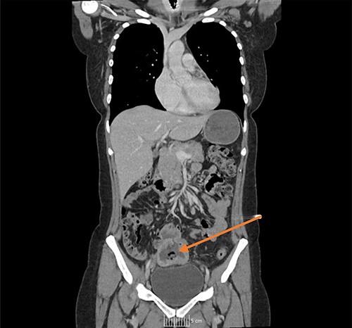 CT coronal image, with arrow showing the midline lower abdominal/pelvic thick walled fluid and gas-filled structure that measured 5 × 7 × 6 cm.