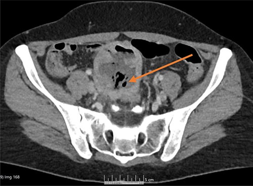CT axial image, with arrow showing the midline lower abdominal/pelvic thick-walled fluid and gas-filled structure that measured 5 × 7 × 6 cm.