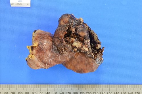 Macroscopic view of the ruptured GIST.