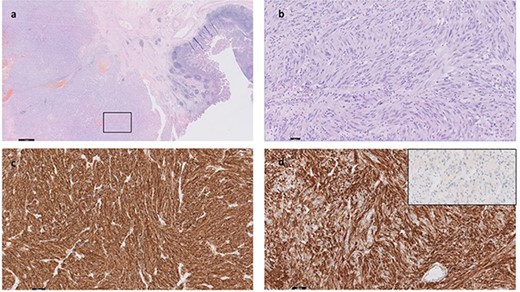 The malignancy consists of diffuse sheets and fascicles of pleomorphic and atypical cells with nuclear hyperchromasia and irregular nuclear membranes; there are focal intra-nuclear inclusions; The cells have fairly abundant eosinophilia cytoplasm; <5 mitoses per 5 mm2; CD117 (KIT) IHC is positive (c). CD34 IHC positive (d). MelanA is negative (inset, d). DOG1, Desmin and PanCK are negative (not shown). The boxed area in (a) is shown in high magnification in (b).