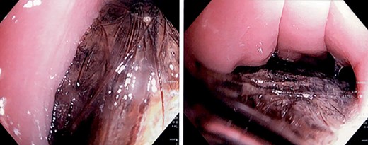 EGD with presence of trichobezoar in stomach.
