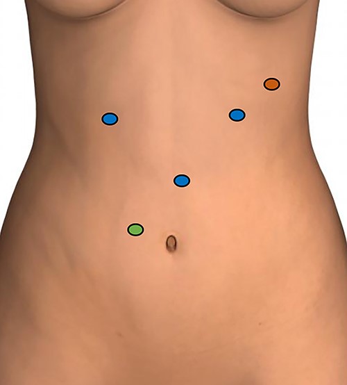 Port placement; blue circles: 8-mm robotic ports; green circle: 12-mm assistant port; red circle: 5-mm assistant port.