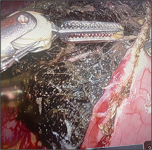 Gastrostomy with removal of trichobezoar.