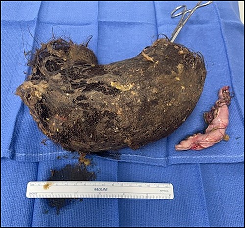 Trichobezoar.