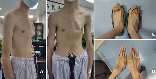 (A) and (B) appearance of chest wall before operation, (C) feet and (D) hands.