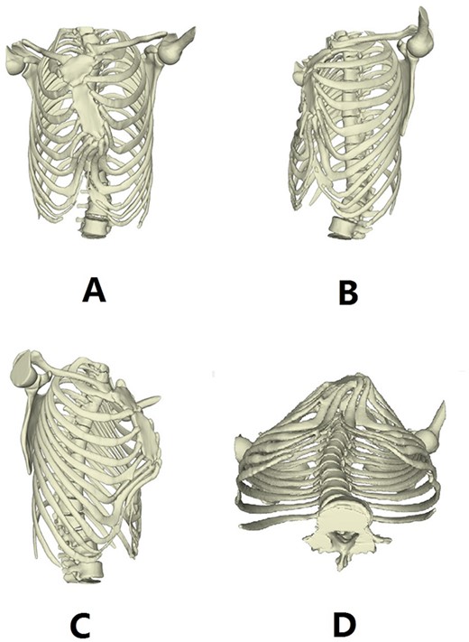 3D reconstruction images of thorax before operation.