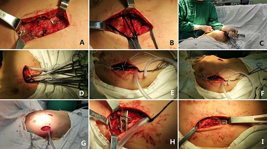 (A), (B), (C), (D), (E), (F), (G) and (H) surgical field of Wenlin procedure; and (I) surgical field after Wung procedure.
