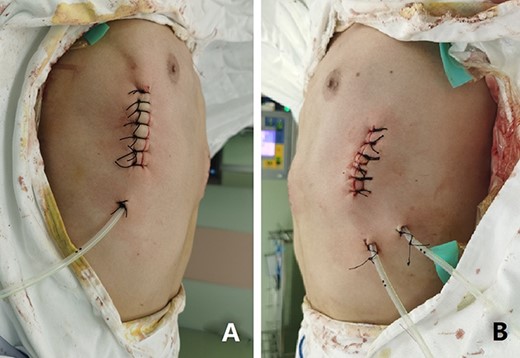 Appearance of chest wall after operation.