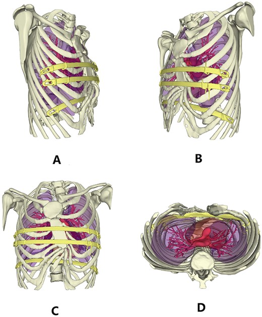 3D reconstruction images of thorax after operation.