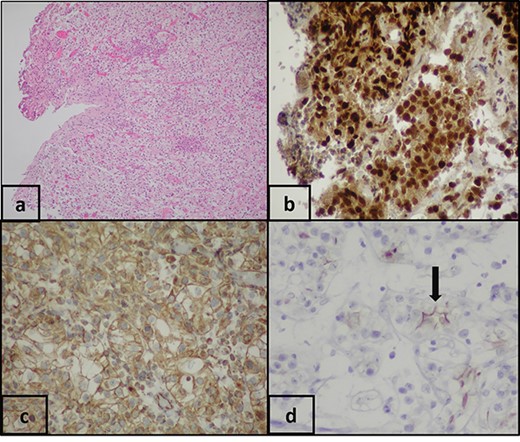 (a) Pathologic examination shows bladder biopsy with clear-cell carcinoma (H&E, ×100). Immunohistochemical staining shows that the clear cells are positive for: (b) PAX-8 (PAX-8, ×200), (c) vimentin (vimentin, ×200) and (d) EMA (EMA, ×200).