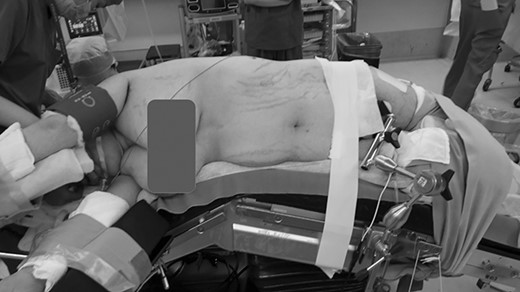 Lateral jackknife position. The right buttock is at the apex, supporting the patient’s weight. However, this is an intraoperative photograph of a patient different from the one shown here.